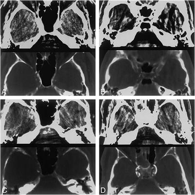 Arterial Calcification and Its Association With Stroke: Implication of Risk, Prognosis, Treatment Response, and Prevention